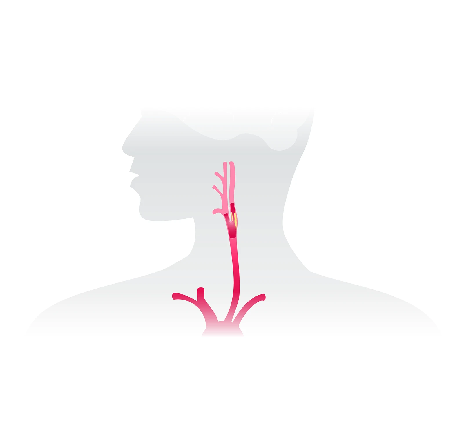 arterybody