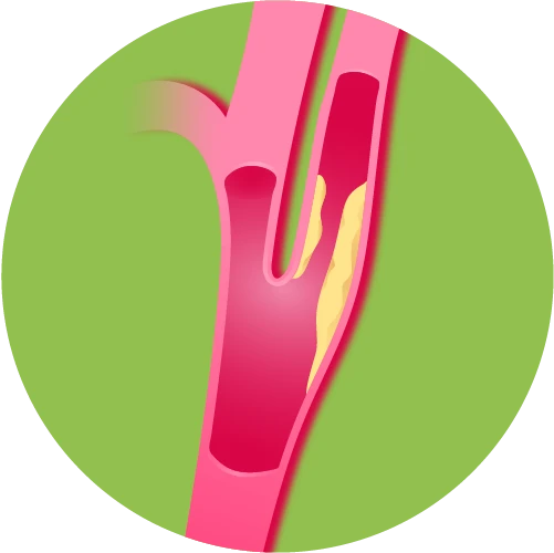 embolism
